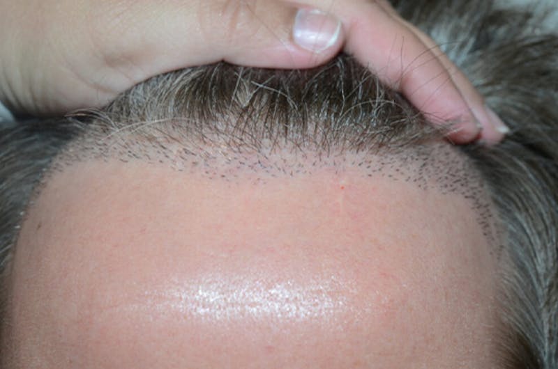 Hair Restoration for Men Before & After Gallery - Patient 427466 - Image 1