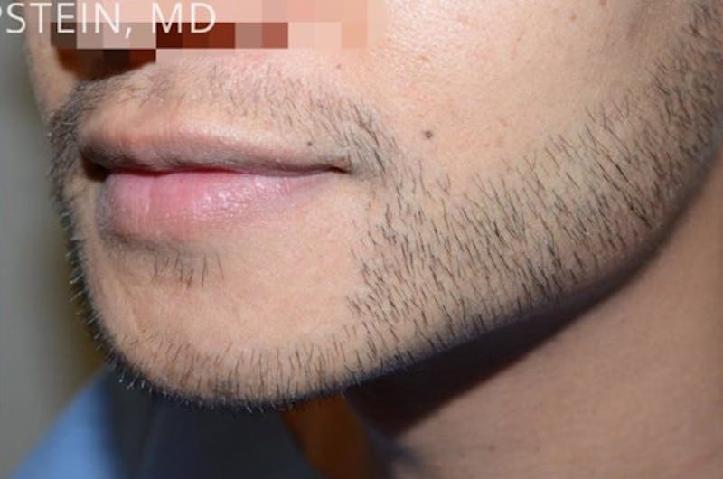 Facial Hair Transplant Before & After Gallery - Patient 294368 - Image 2