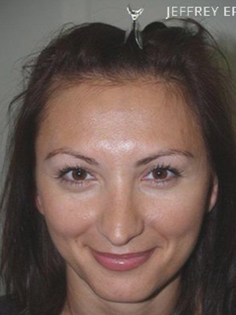 Hair Procedures for Women Before & After Gallery - Patient 228455 - Image 1