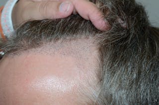 Hair Transplant Repair Before & After Gallery - Patient 119367 - Image 4