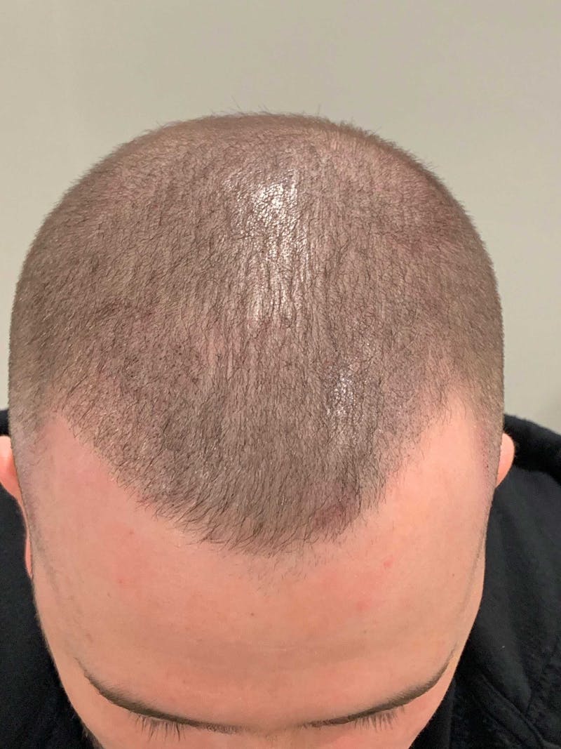 Scalp Micropigmentation Procedures Before & After Gallery - Patient 261665 - Image 2
