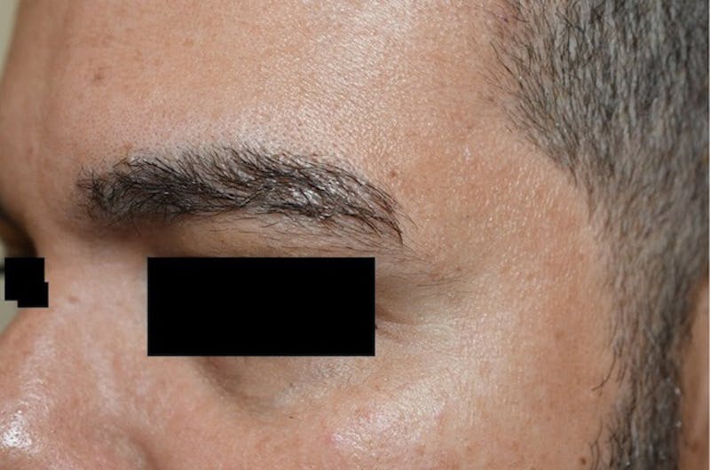 Eyebrow Transplantation Before & After Gallery - Patient 275303 - Image 4
