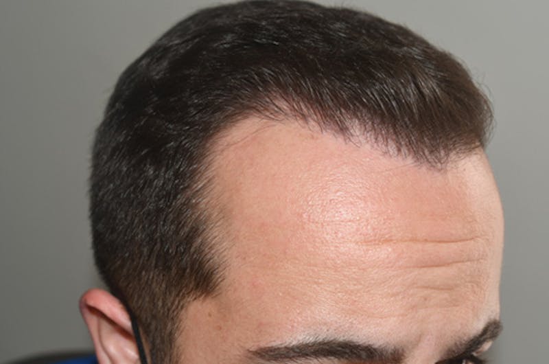 Hair Restoration for Men Before & After Gallery - Patient 162049 - Image 6
