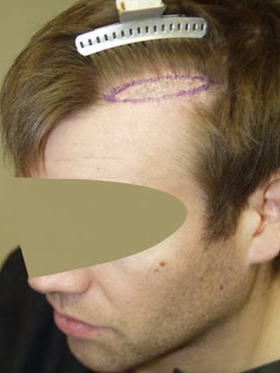 Hair Transplant Repair Before & After Gallery - Patient 326267 - Image 1