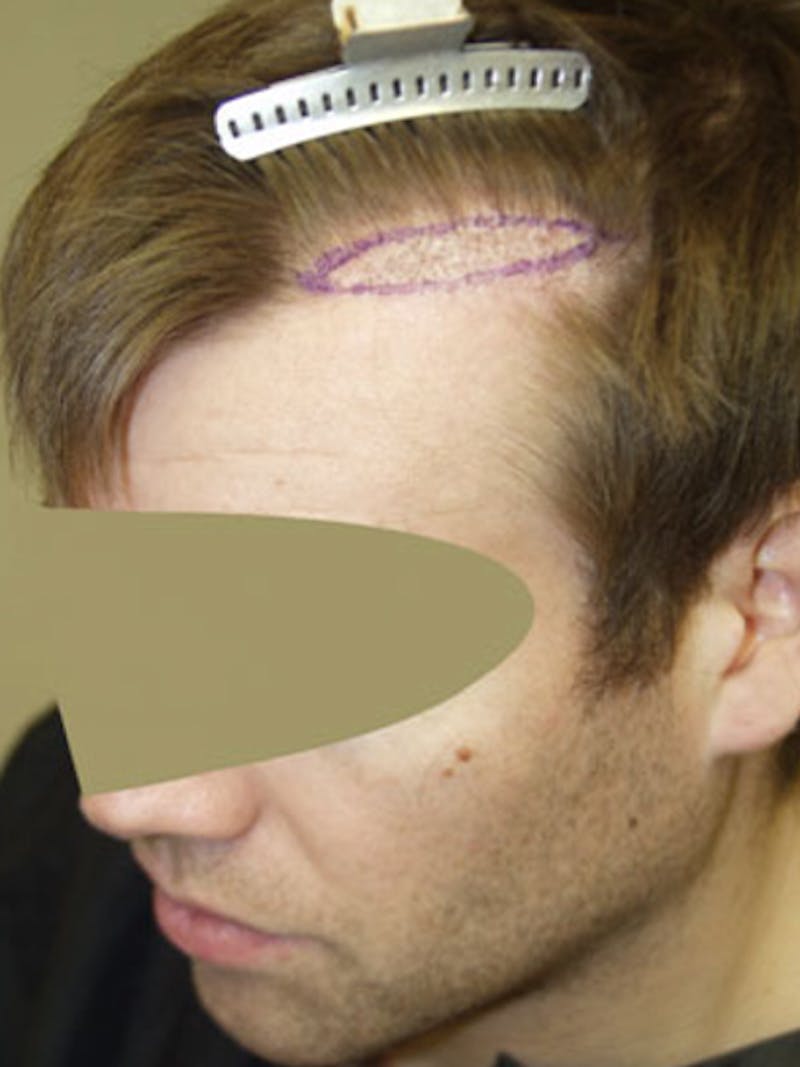 Hair Restoration for Men Before & After Gallery - Patient 356583 - Image 1