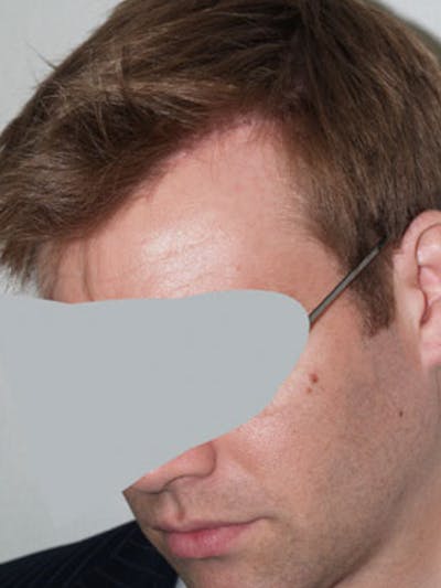 Hair Transplant Repair Before & After Gallery - Patient 326267 - Image 2