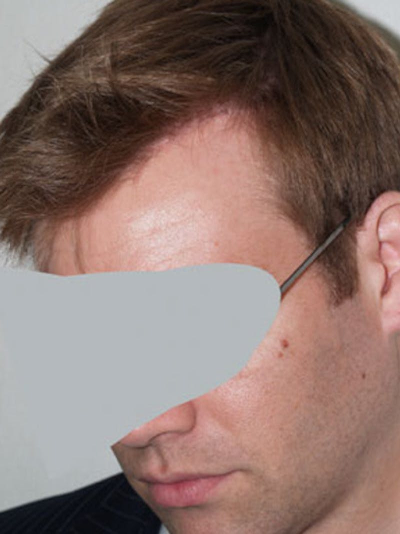 Hair Restoration for Men Before & After Gallery - Patient 356583 - Image 2