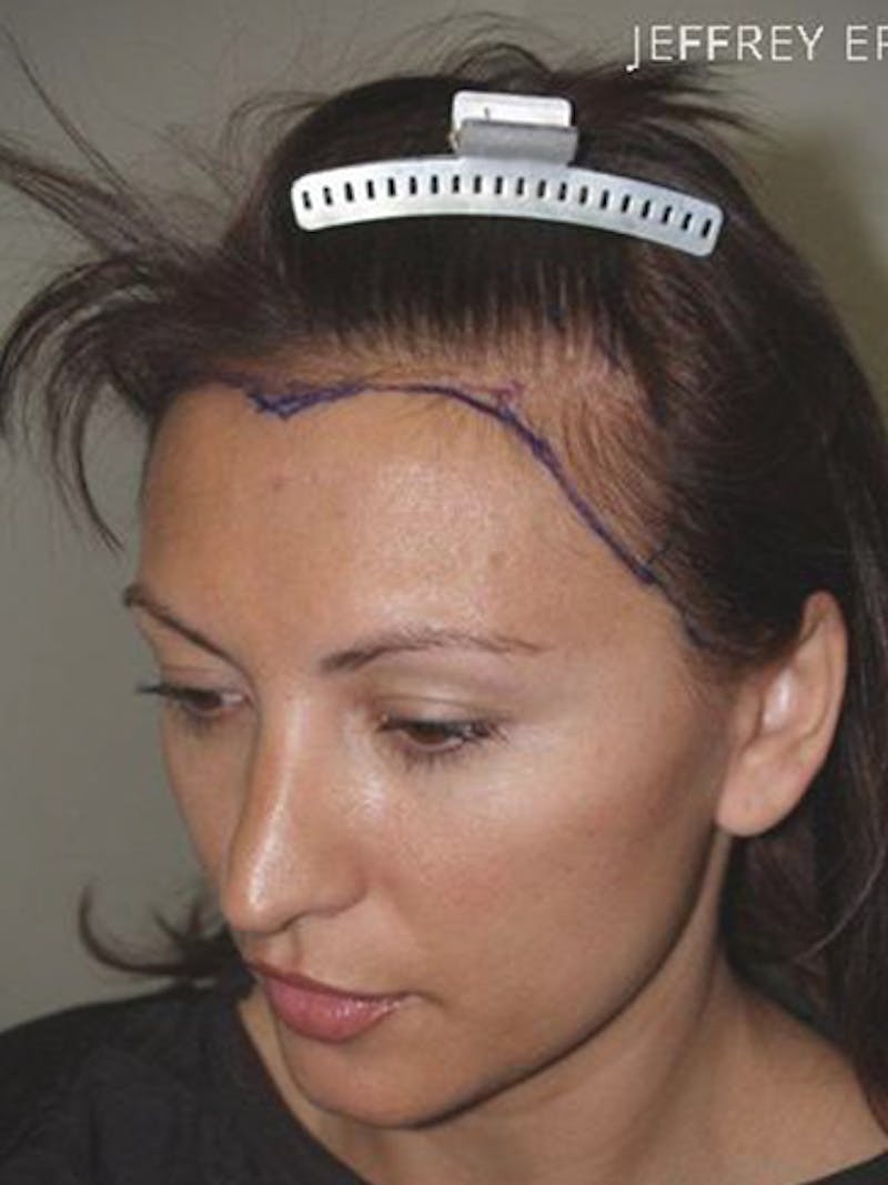 Hair Procedures for Women Before & After Gallery - Patient 228455 - Image 3