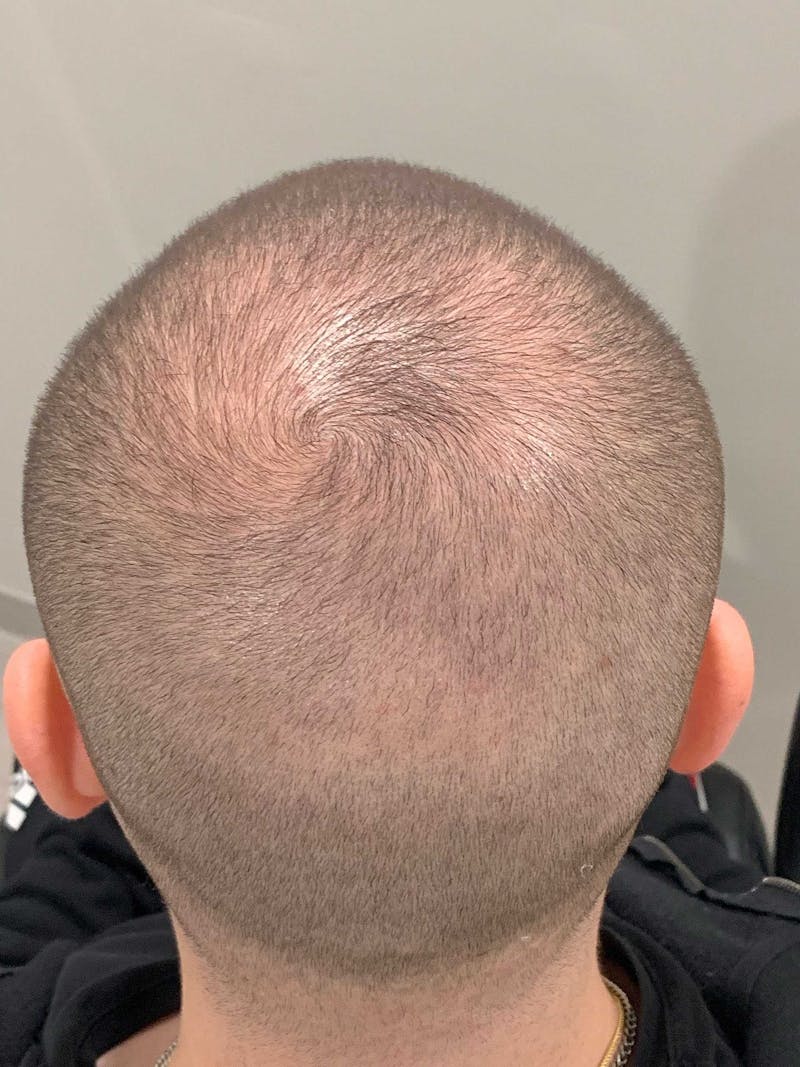 Scalp Micropigmentation Procedures Before & After Gallery - Patient 261665 - Image 3
