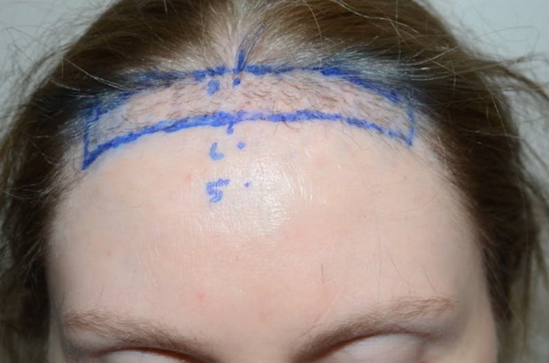 Hairline Lowering Surgery Before & After Gallery - Patient 306857 - Image 1