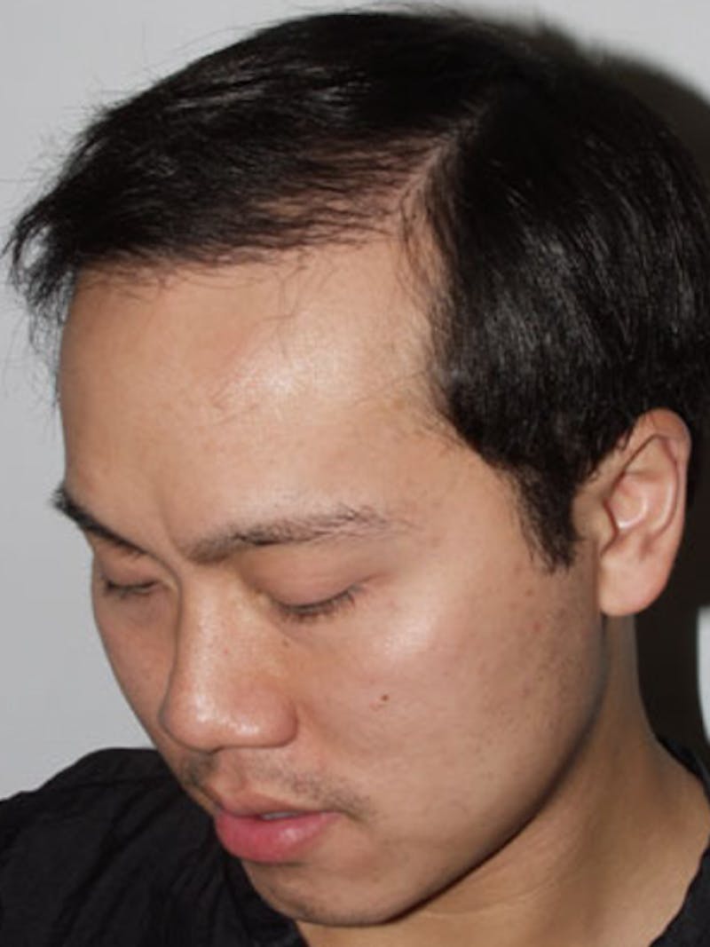 Hair Restoration for Men Before & After Gallery - Patient 100068 - Image 1