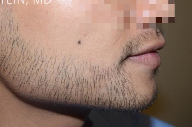 Facial Hair Transplant Before & After Gallery - Patient 294368 - Image 6