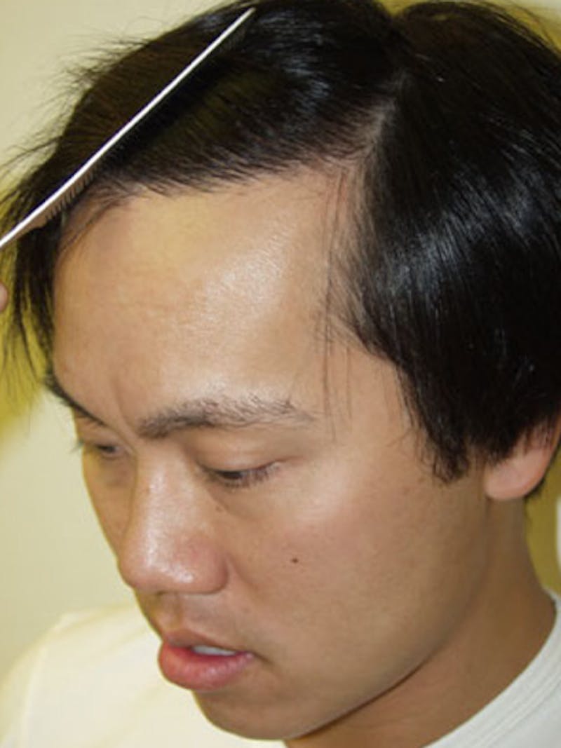 Hair Restoration for Men Before & After Gallery - Patient 100068 - Image 2