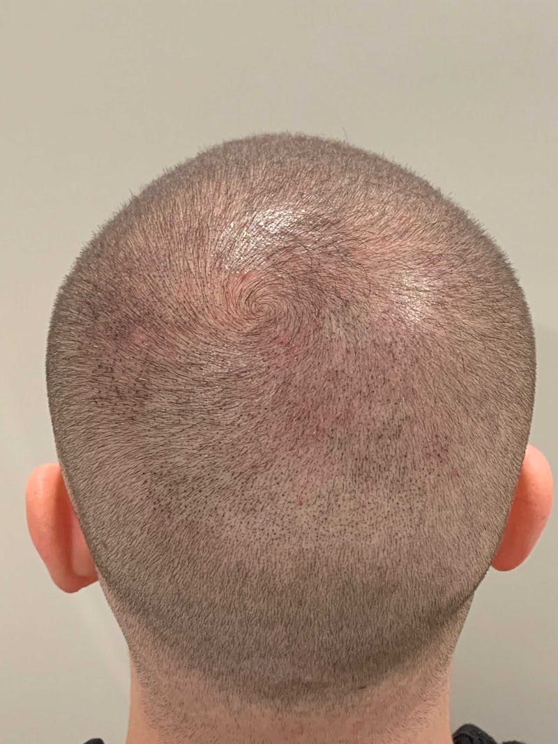 Scalp Micropigmentation Procedures Before & After Gallery - Patient 261665 - Image 4