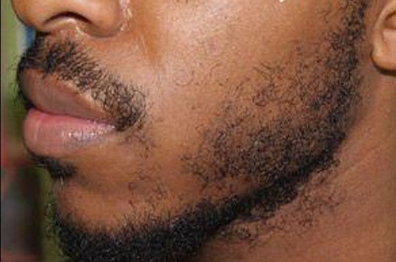 Facial Hair Transplant Before & After Gallery - Patient 225342 - Image 1