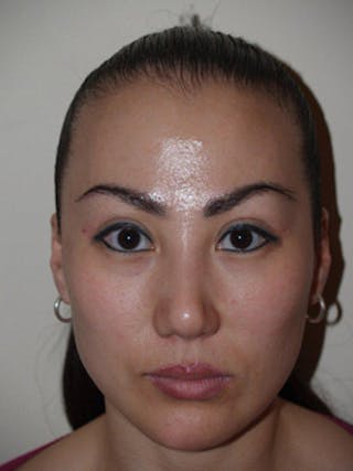Eyebrow Transplantation Before & After Gallery - Patient 212250 - Image 2