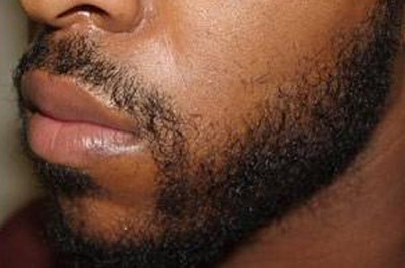 Facial Hair Transplant Before & After Gallery - Patient 225342 - Image 2