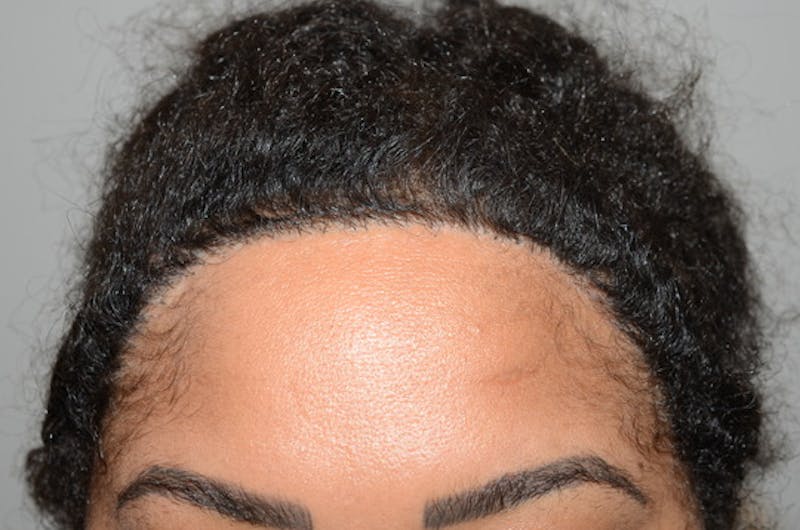 Hair Transplant Repair Before & After Gallery - Patient 562169 - Image 2