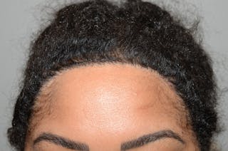 Hair Transplant Repair Before & After Gallery - Patient 562169 - Image 2