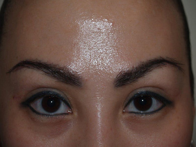 Eyebrow Transplantation Before & After Gallery - Patient 342087 - Image 4