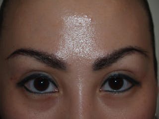 Eyebrow Transplantation Before & After Gallery - Patient 212250 - Image 4