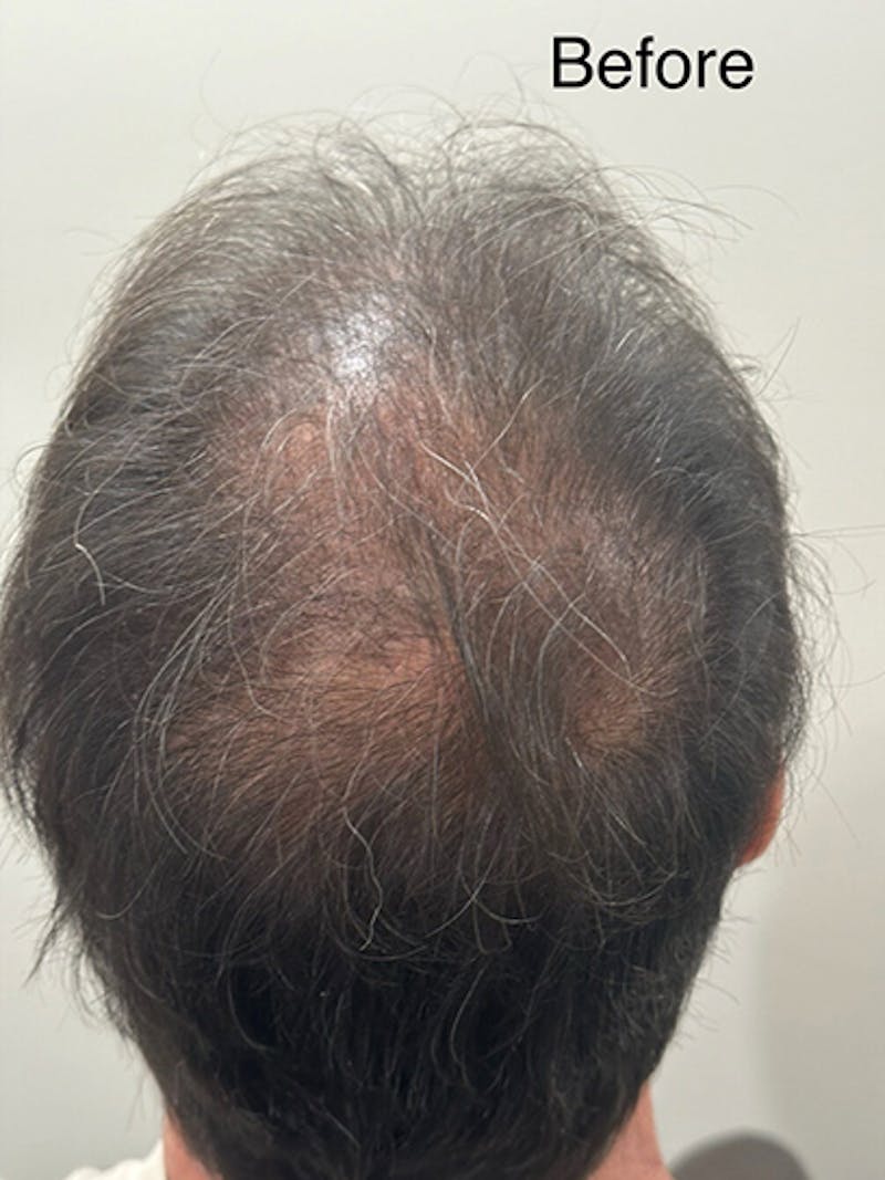 Scalp Micropigmentation Procedures Before & After Gallery - Patient 205584 - Image 1