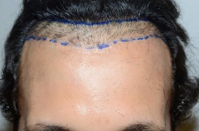 Hairline Lowering Surgery Before & After Gallery - Patient 123481 - Image 1