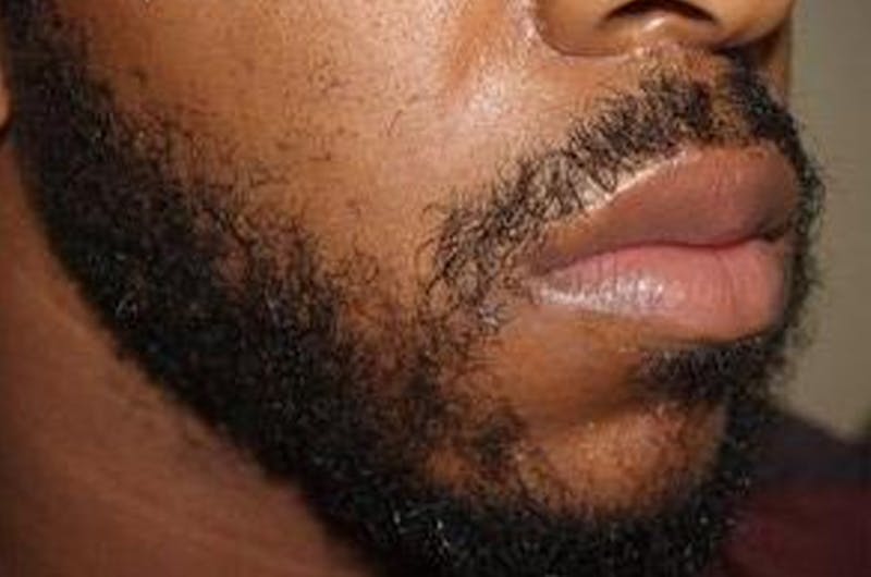 Facial Hair Transplant Before & After Gallery - Patient 225342 - Image 4