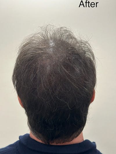 SMP Procedures Before & After Gallery - Patient 362520 - Image 2
