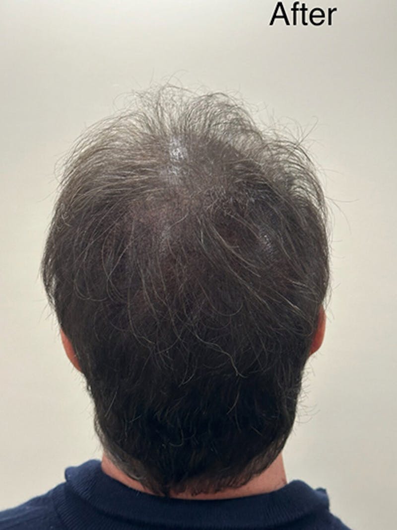 Scalp Micropigmentation Procedures Before & After Gallery - Patient 205584 - Image 2