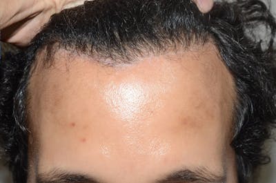 Hairline Lowering Surgery Before & After Gallery - Patient 123481 - Image 2