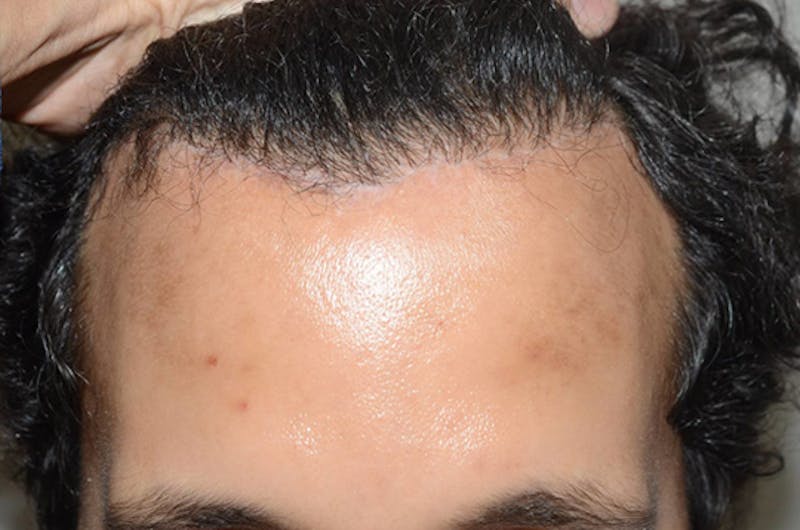 Hair Restoration for Men Before & After Gallery - Patient 439998 - Image 2
