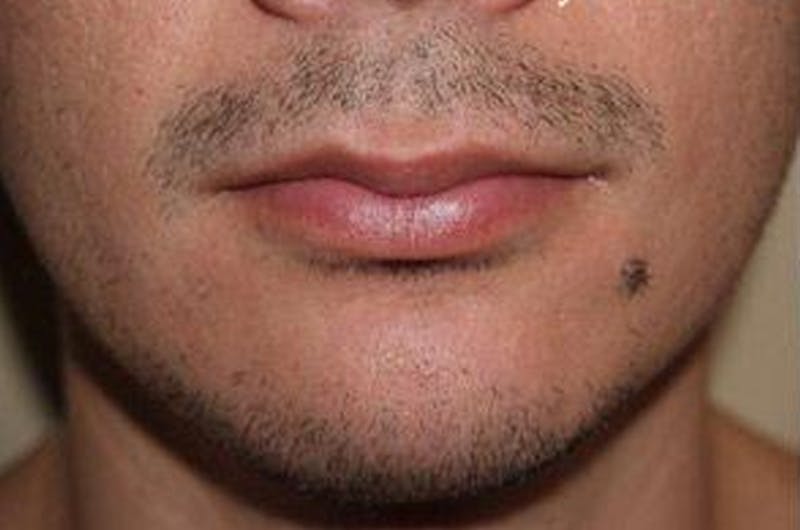 Facial Hair Transplant Before & After Gallery - Patient 148511 - Image 1