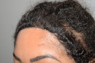 Hair Transplant Repair Before & After Gallery - Patient 562169 - Image 4