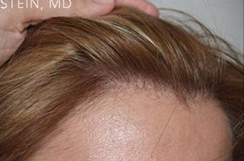 Hair Procedures for Women Before & After Gallery - Patient 228455 - Image 8