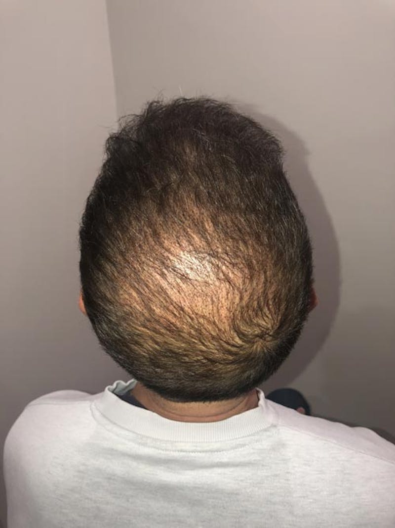 Scalp Micropigmentation Procedures Before & After Gallery - Patient 111192 - Image 1