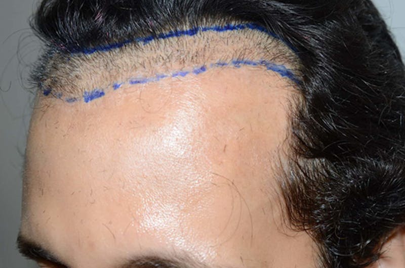 Hair Restoration for Men Before & After Gallery - Patient 439998 - Image 3