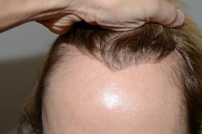 Special Cases Before & After Gallery - Patient 238883 - Image 1