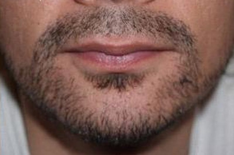 Facial Hair Transplant Before & After Gallery - Patient 148511 - Image 2