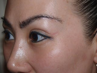Eyebrow Transplantation Before & After Gallery - Patient 212250 - Image 6