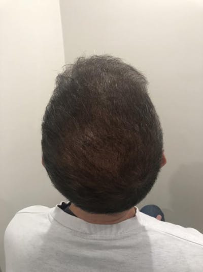 SMP Procedures Before & After Gallery - Patient 288745 - Image 2