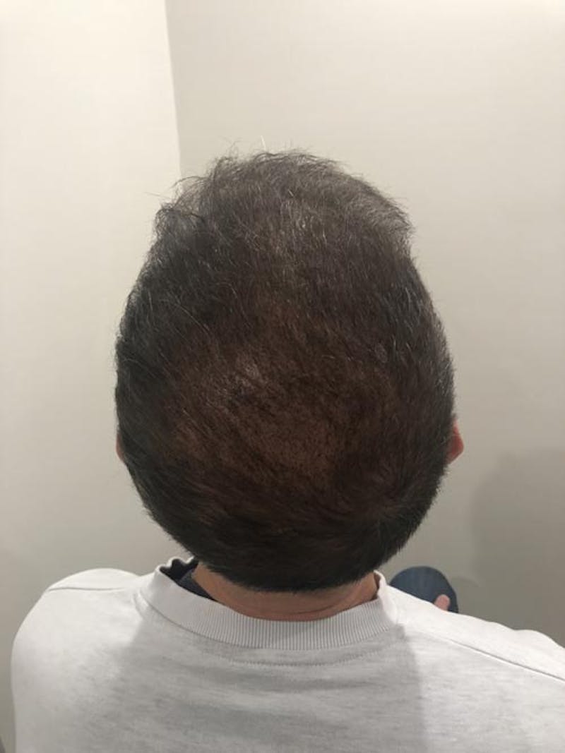 Scalp Micropigmentation Procedures Before & After Gallery - Patient 111192 - Image 2