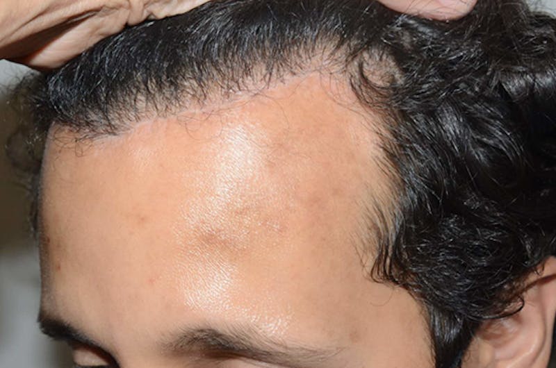 Hair Restoration for Men Before & After Gallery - Patient 439998 - Image 4