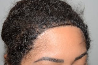 Hair Transplant Repair Before & After Gallery - Patient 562169 - Image 6