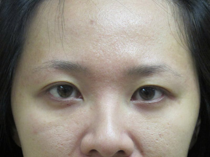 Eyebrow Transplantation Before & After Gallery - Patient 273248 - Image 1