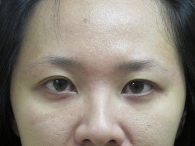 Eyebrow Transplantation Before & After Gallery - Patient 636838 - Image 1