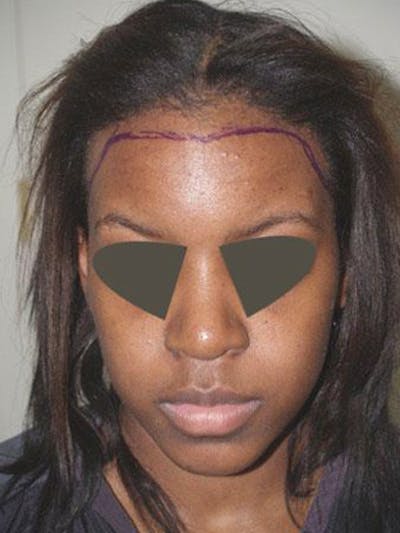 Hair Procedures for Women Before & After Gallery - Patient 429891 - Image 1