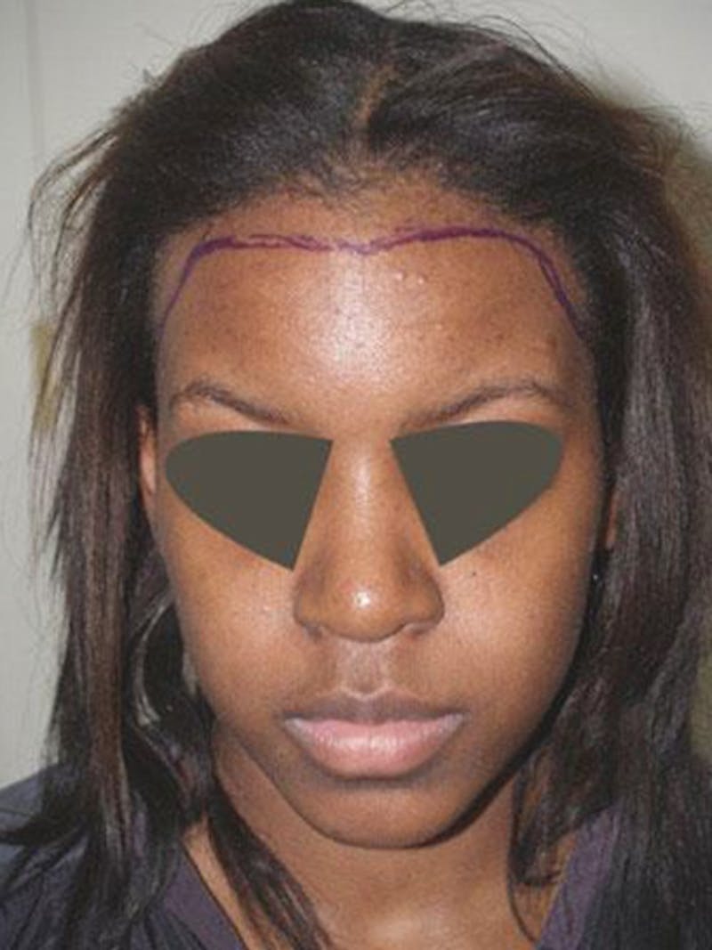 Hair Procedures for Women Before & After Gallery - Patient 242963 - Image 1