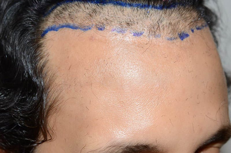 Hair Restoration for Men Before & After Gallery - Patient 439998 - Image 5