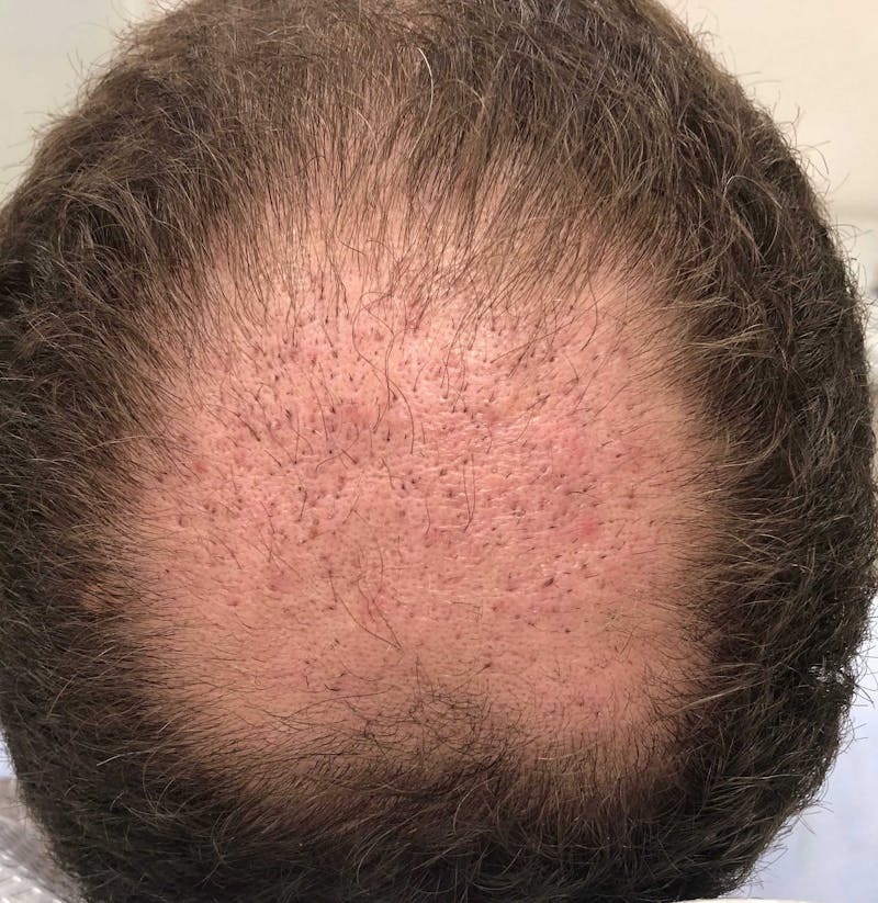 Scalp Micropigmentation Procedures Before & After Gallery - Patient 386466 - Image 1